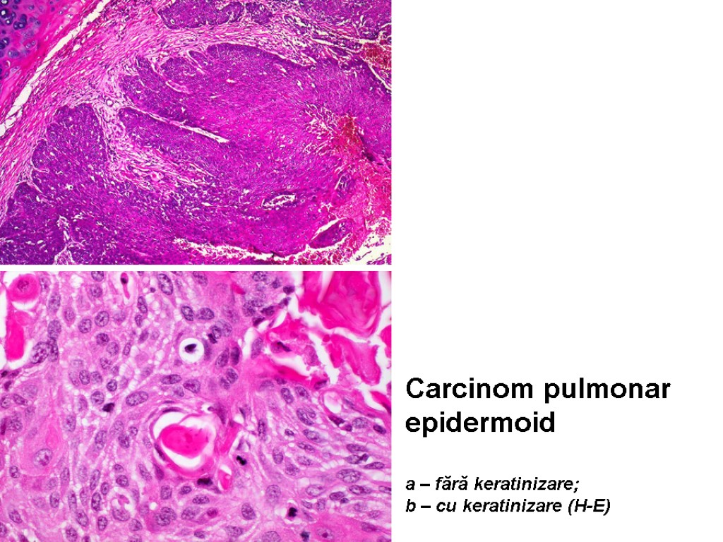 Carcinom pulmonar epidermoid a – fără keratinizare; b – cu keratinizare (H-E)